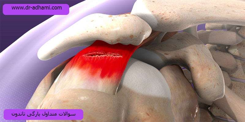 سوالات متداول-پارگی-تاندون-شانه