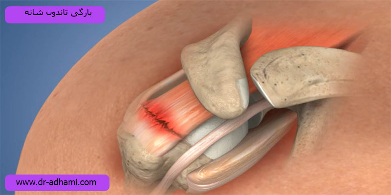 پارگی-تاندون-شانه