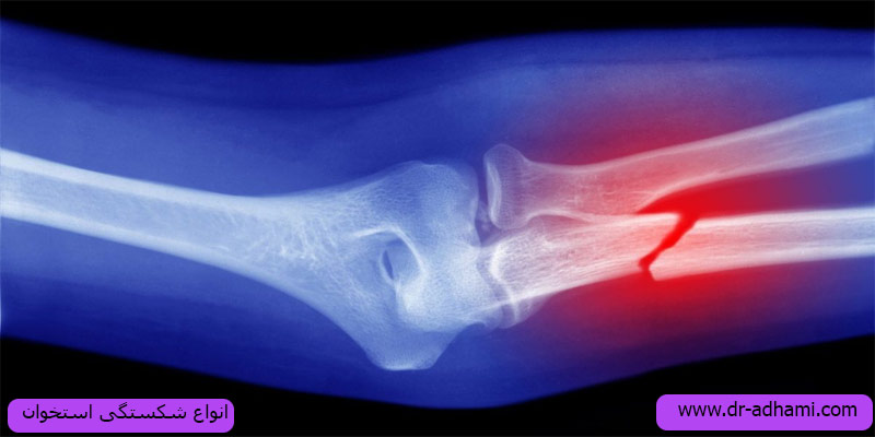 انواع-شکستگی-استخوان
