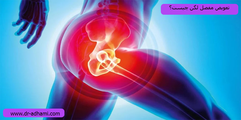 تعویض-مفصل-لگن