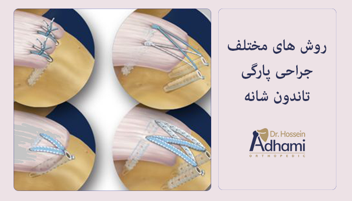 روش های مختلف عمل جراحی پارگی تاندون شانه