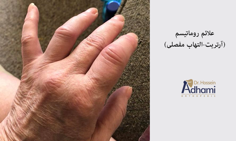 علائم آرتریت