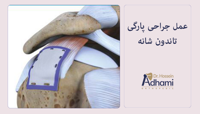 عمل جراحی پارگی تاندون شانه