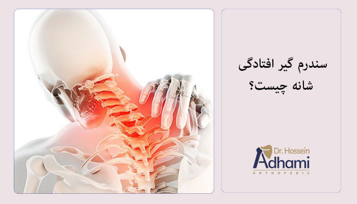 سندرم-گیر-افتادگی-شانه-چیست؟