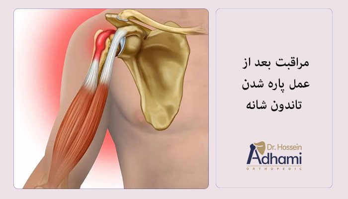 مراقبت-های-بعد-از-عمل-پاره-شدن-تاندون-شانه
