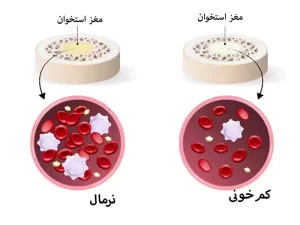 تخریب مفصل شانه در اثر کم‌خونی