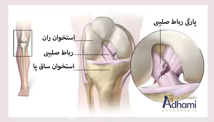 جراحی رباط صلیبی قدامی زانو چیست؟