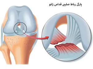 جراحی پارگی رباط صلیبی قدامی زانو