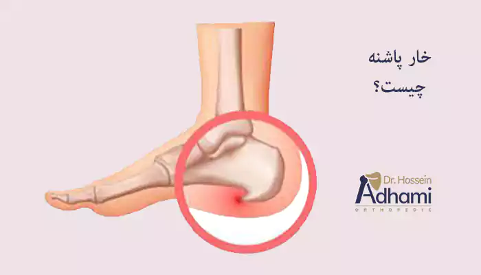 خار پاشنه چیست؟