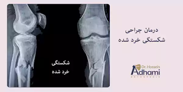 درمان جراحی شکستگی خرد شده