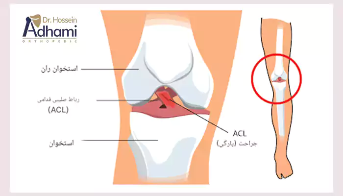 رباط صلیبی قدامی چیست؟