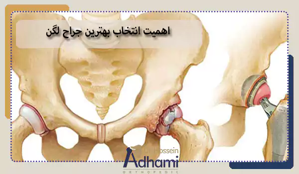 اهمیت انتخاب بهترین جراح لگن