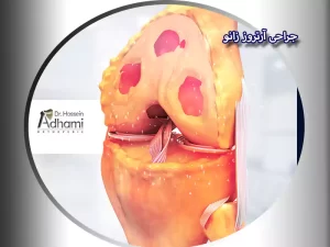 جراحی آرتروز زانو