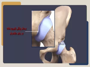 درمان پارگی لابروم شانه در بابل مازندران
