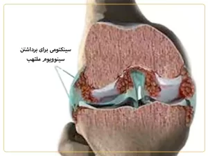 سینکتومی در بابل مازندران