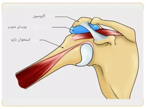 درمان بورسیت شانه در بابل مازندران